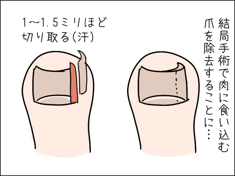 イラストエッセー　毎日がエンタメ　らぶこ　さわ　ソウル旅行　巻き爪